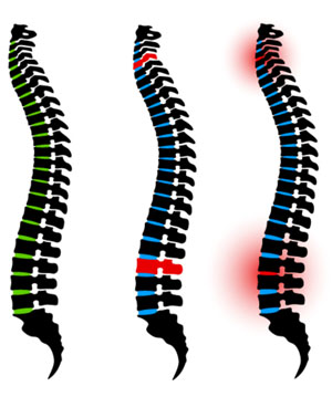 chiropractic spine clipart